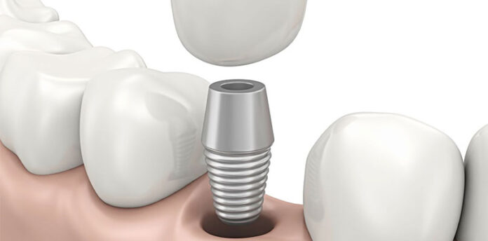 Implantes Dentales Madrid