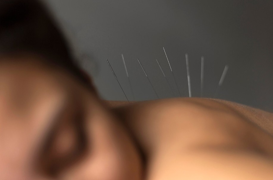 La acupuntura es un ejemplo de pseudoterapia como el biomagnetismo